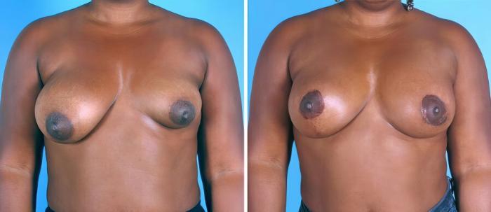 Breast Asymmetry Before & After Case 19289
