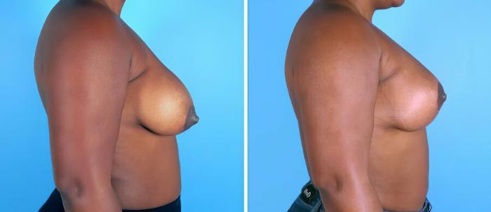 Breast Asymmetry Before & After Case 19289