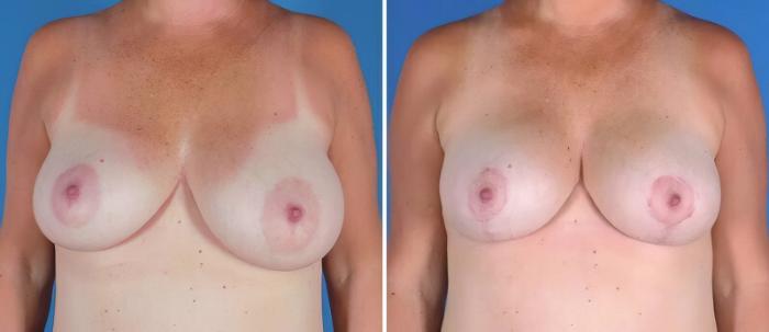 Breast Asymmetry Before & After Case 22918