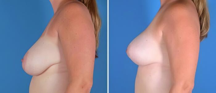 Breast Asymmetry Before & After Case 22918