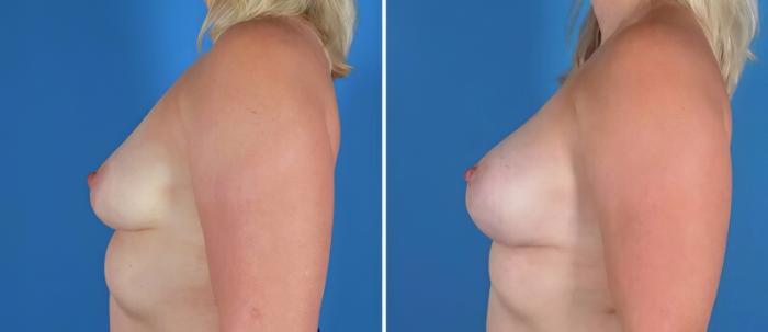 Breast Asymmetry Before & After Case 22921