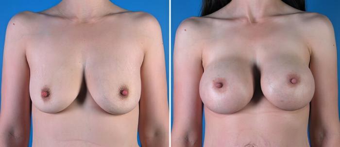 Breast Asymmetry Before & After Case 25782