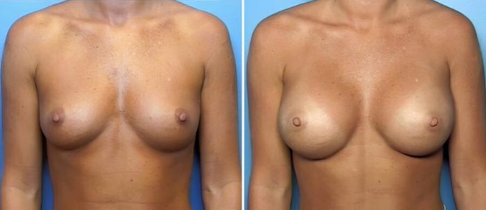 Breast Augmentation Before & After Case 16414