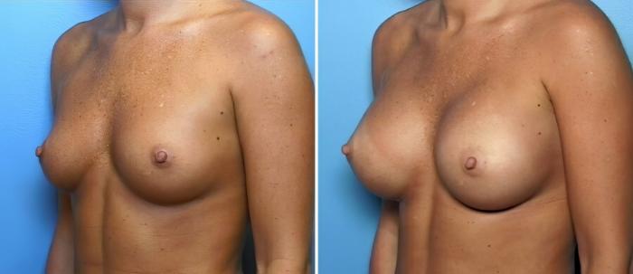 Breast Augmentation Before & After Case 16414