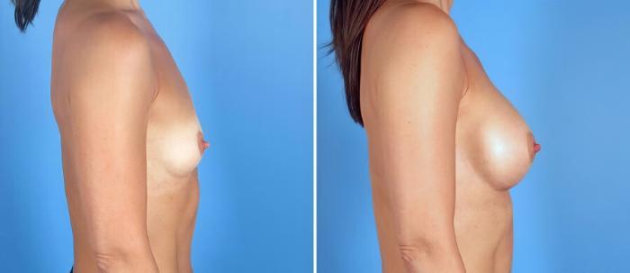 Breast Augmentation Before & After Case 17088
