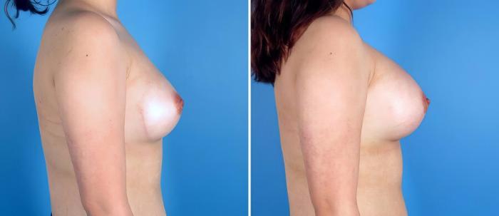 Breast Augmentation Before & After Case 17091