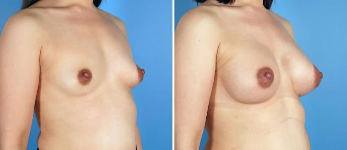Breast Augmentation Before & After Case 17094