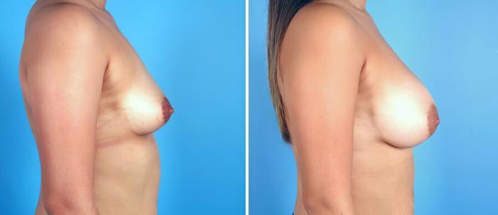 Breast Augmentation Before & After Case 17100