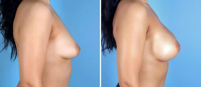 Breast Augmentation Before & After Case 17103