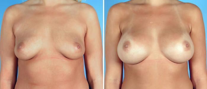 Breast Augmentation Before & After Case 17106