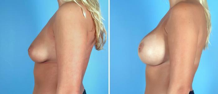 Breast Augmentation Before & After Case 17106