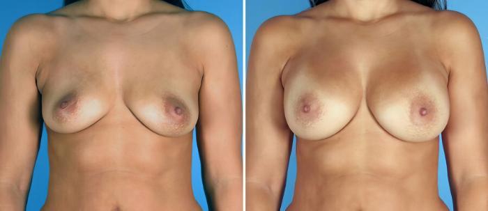 Breast Augmentation Before & After Case 17609