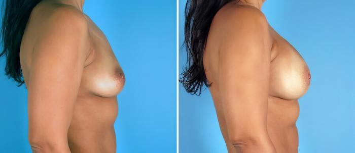 Breast Augmentation Before & After Case 17609