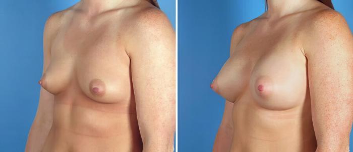 Breast Augmentation Before & After Case 17612