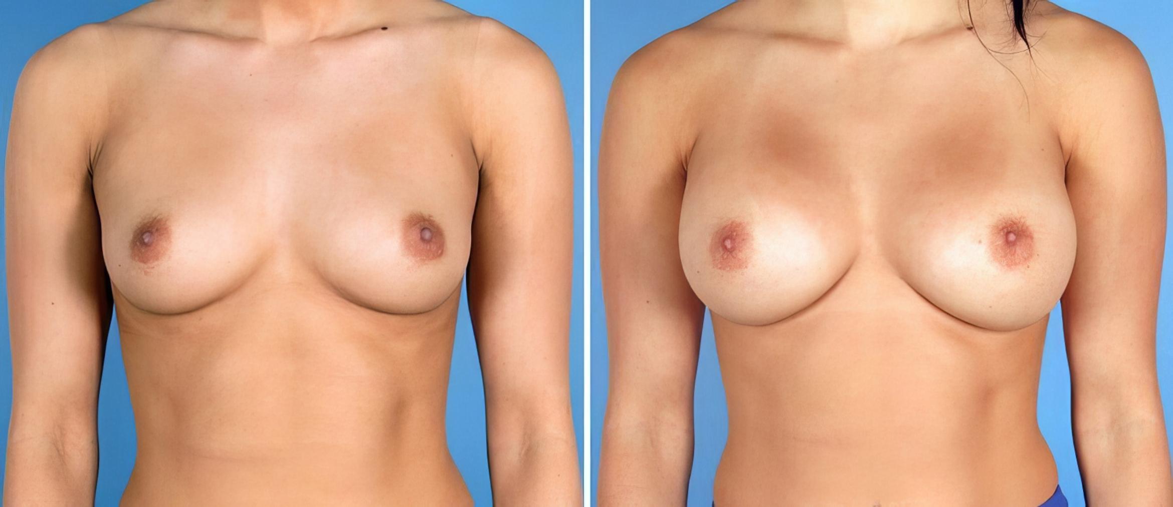 Breast Augmentation Before & After Case 17618
