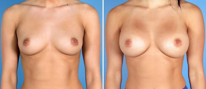 Breast Augmentation Before & After Case 17618