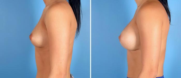 Breast Augmentation Before & After Case 17618