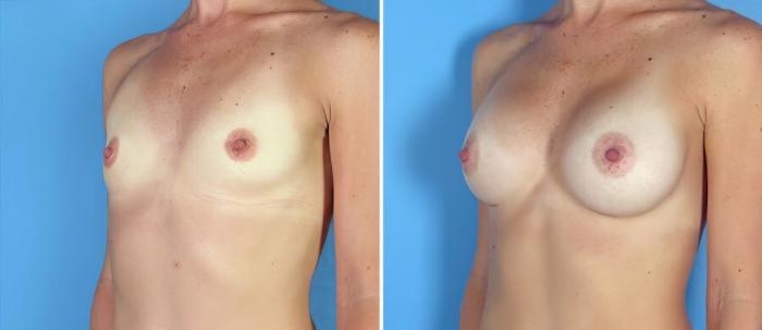 Breast Augmentation Before & After Case 17760