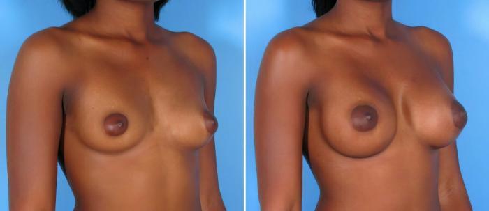 Breast Augmentation Before & After Case 17818