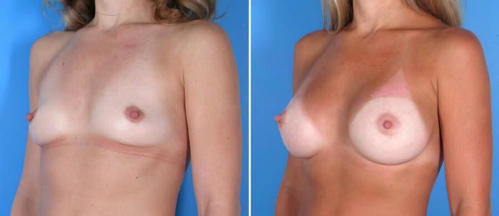 Breast Augmentation Before & After Case 17829