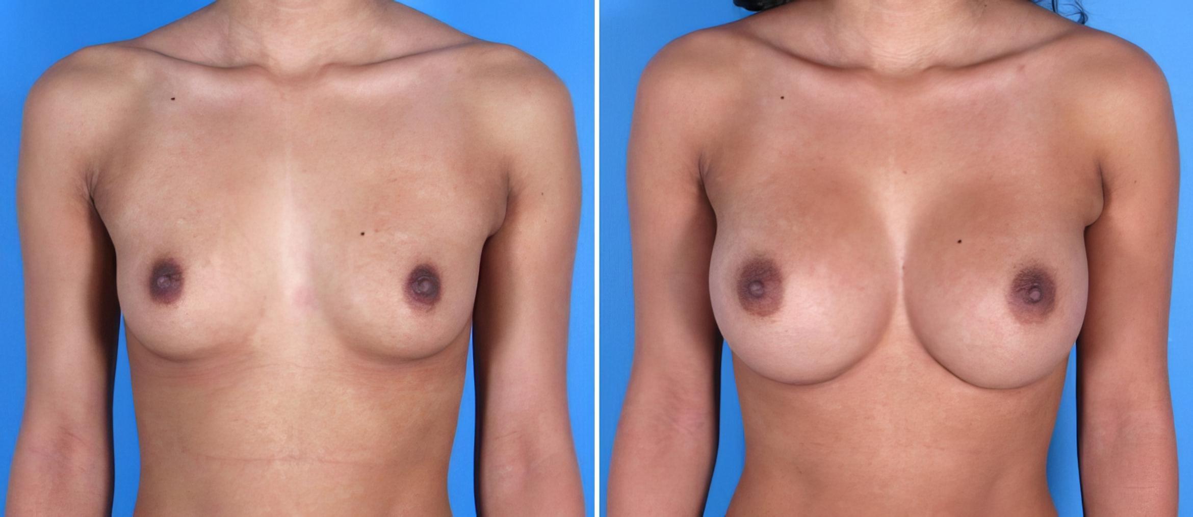Breast Augmentation Before & After Case 17832