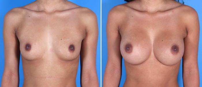 Breast Augmentation Before & After Case 17832