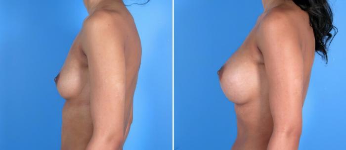 Breast Augmentation Before & After Case 17832