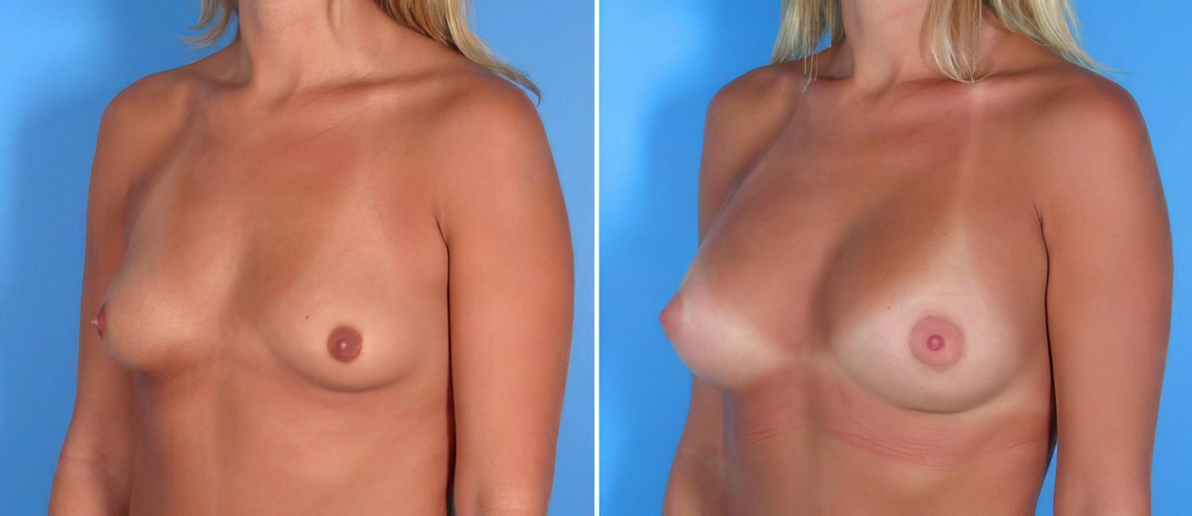 Breast Augmentation Before & After Case 17841