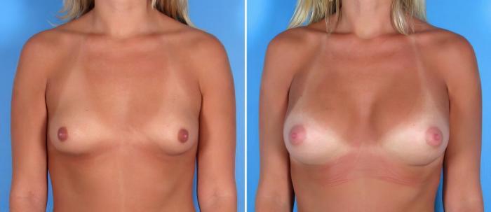 Breast Augmentation Before & After Case 17841