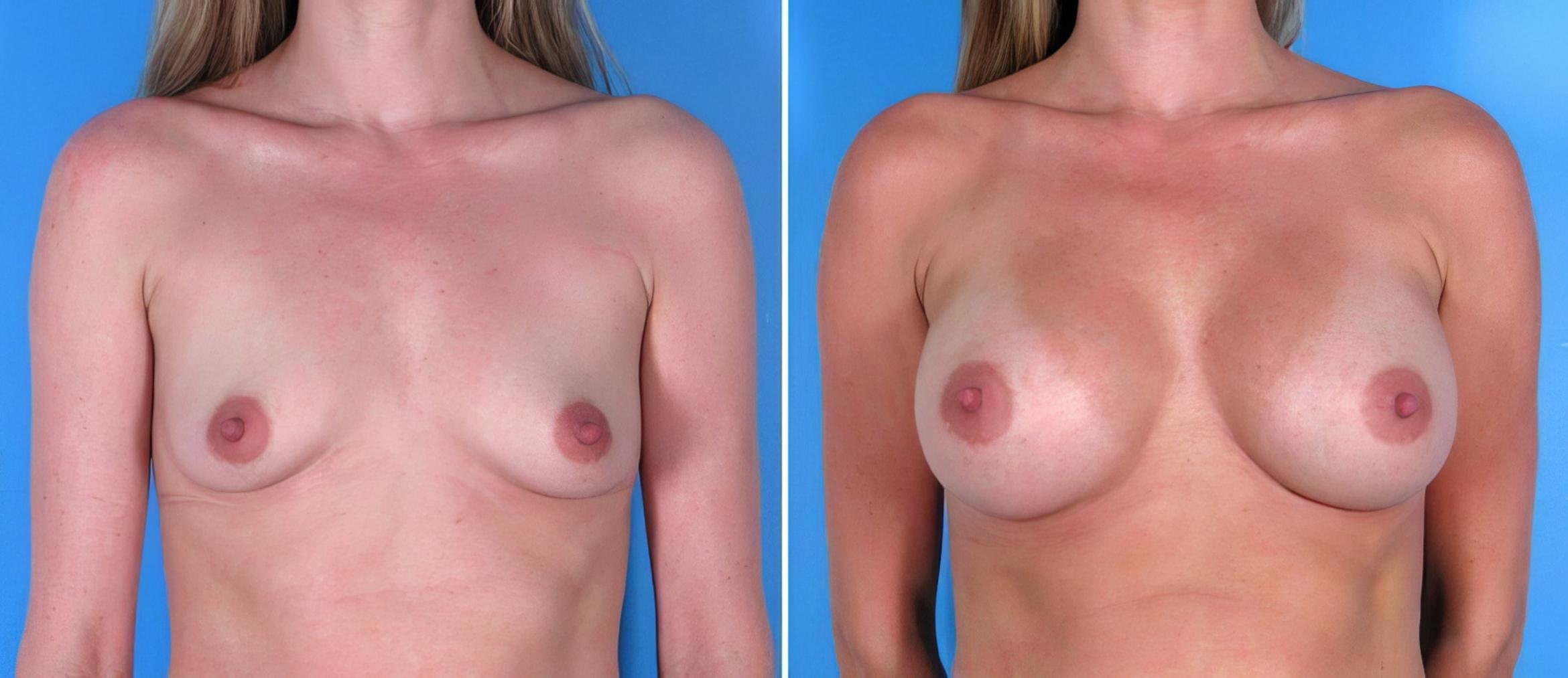 Breast Augmentation Before & After Case 17844