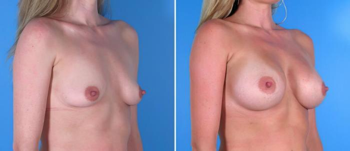 Breast Augmentation Before & After Case 17844