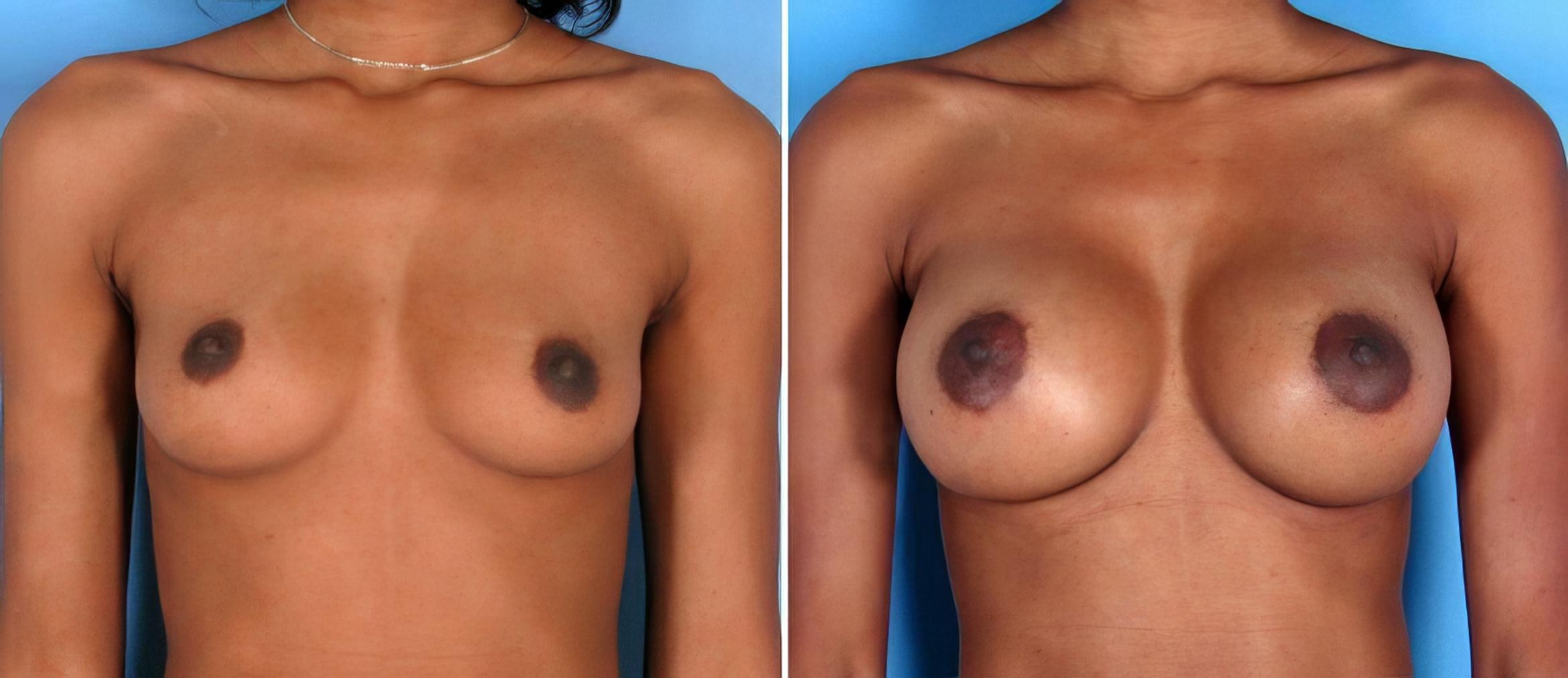 Breast Augmentation Before & After Case 17850