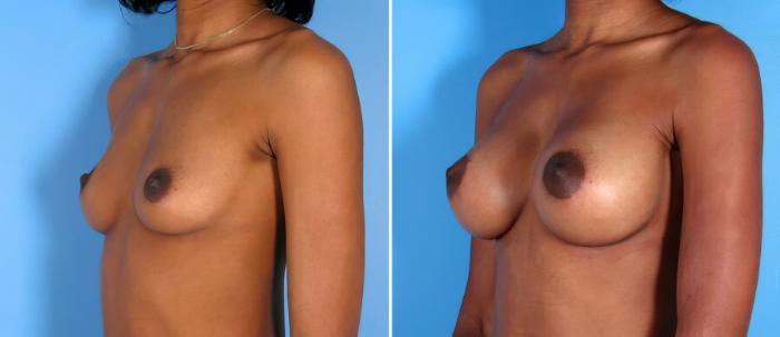 Breast Augmentation Before & After Case 17850