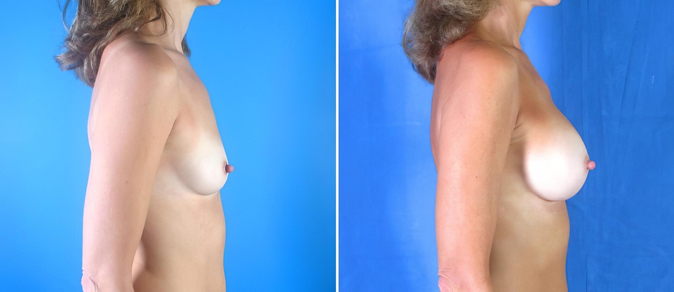 Breast Augmentation Before & After Case 17853