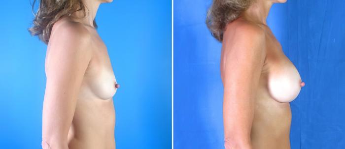 Breast Augmentation Before & After Case 17853