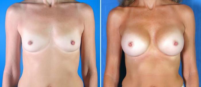 Breast Augmentation Before & After Case 17853