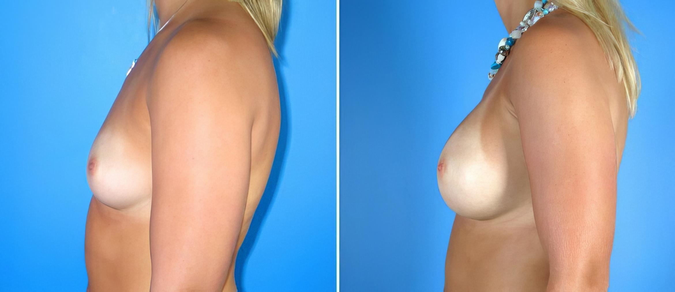 Breast Augmentation Before & After Case 17859