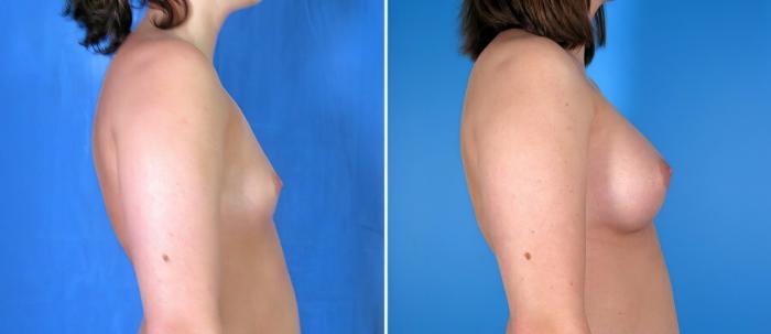 Breast Augmentation Before & After Case 17865