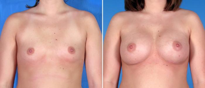 Breast Augmentation Before & After Case 17865