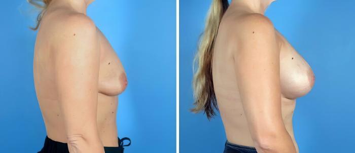 Breast Augmentation Before & After Case 19221