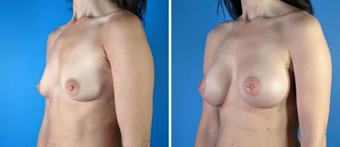 Breast Augmentation Before & After Case 19231