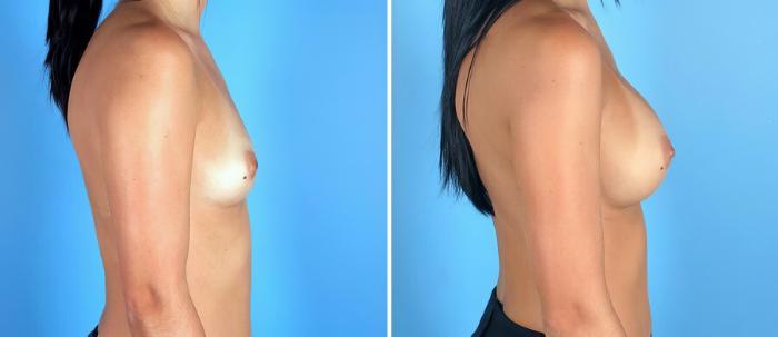 Breast Augmentation Before & After Case 19275