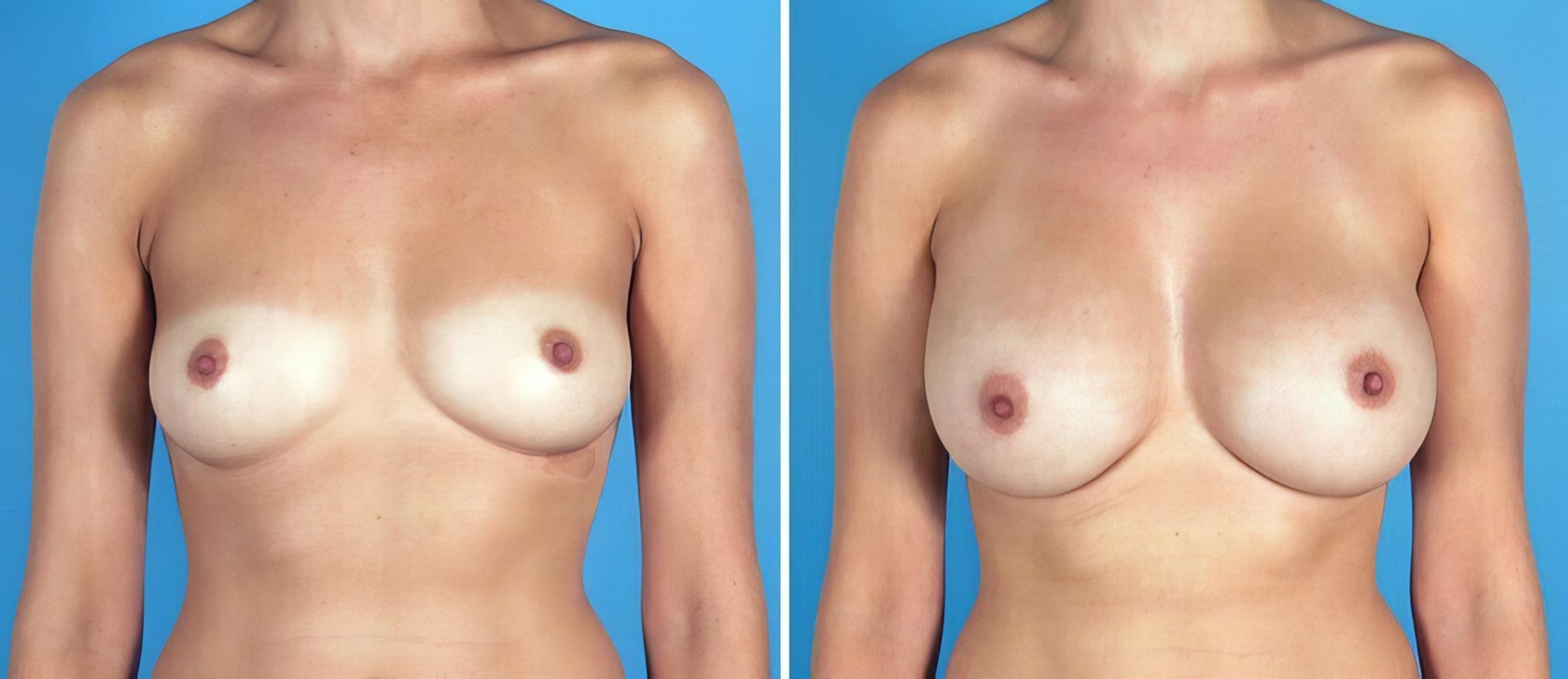 Breast Augmentation Before & After Case 19278
