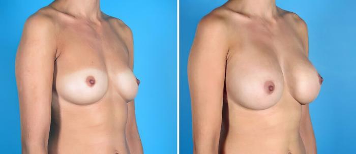 Breast Augmentation Before & After Case 19278