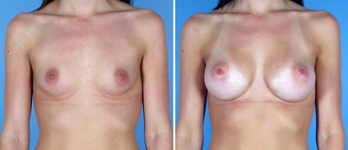 Breast Augmentation Before & After Case 19352