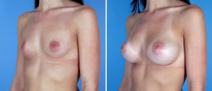 Breast Augmentation Before & After Case 19352