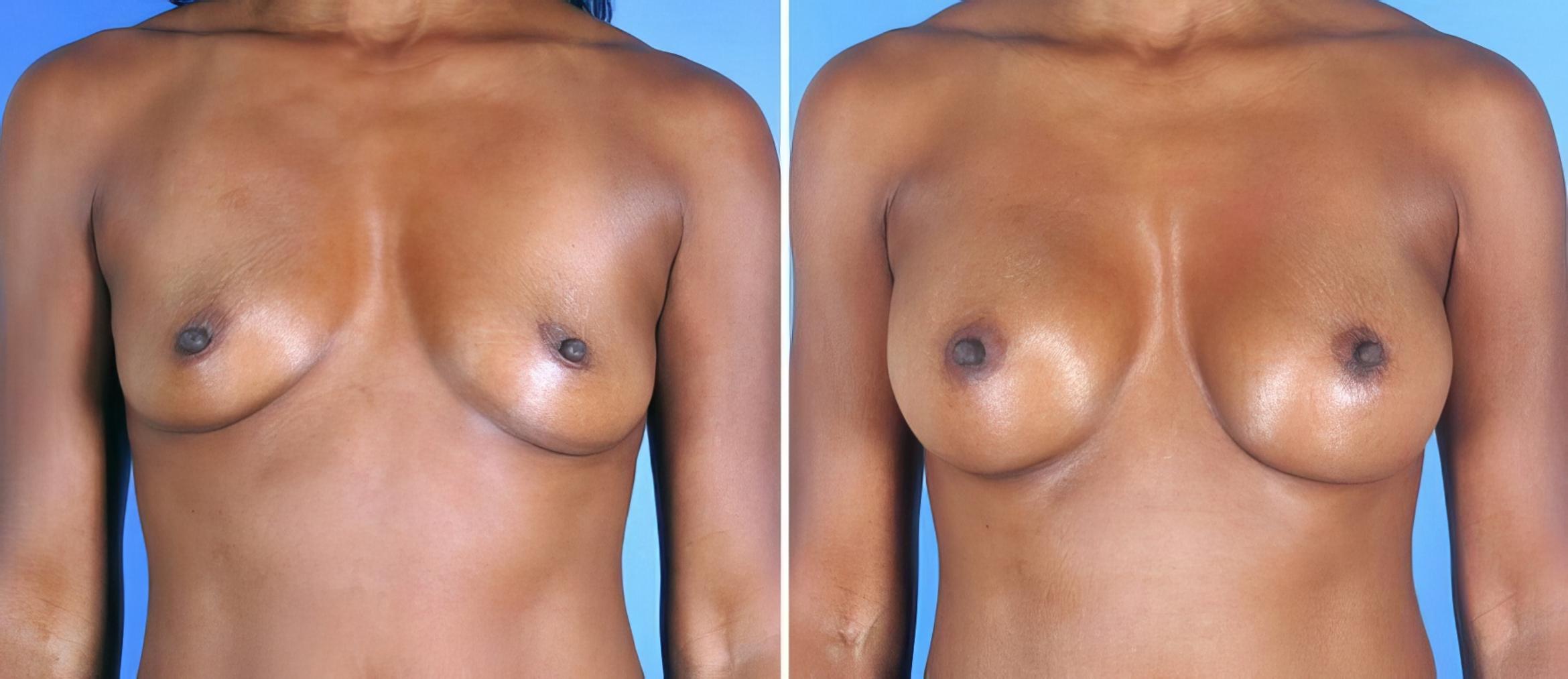 Breast Augmentation Before & After Case 19355