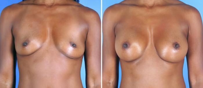 Breast Augmentation Before & After Case 19355
