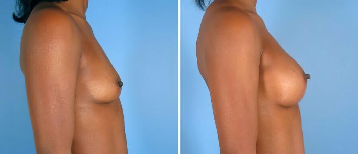 Breast Augmentation Before & After Case 19355