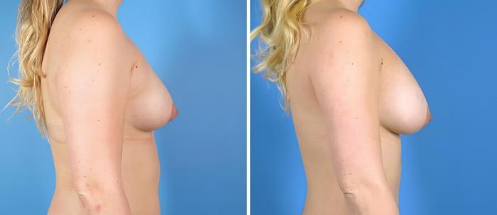 Breast Augmentation Before & After Case 19863